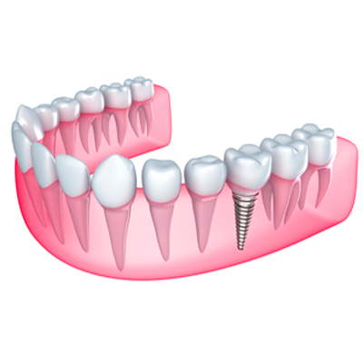Implantología Oral